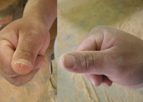 “Just a small nick on his thumb.”