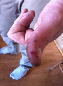 “SawStop saved my finger.”