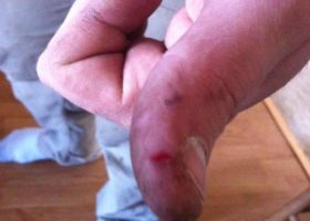 “SawStop saved my finger.”