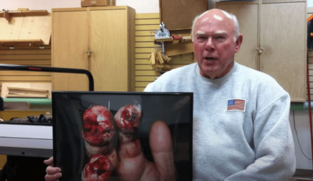 Amputation of Multiple Fingers