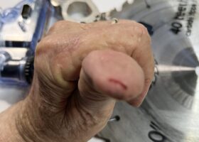 New SawStop Prevents Serious Injury 