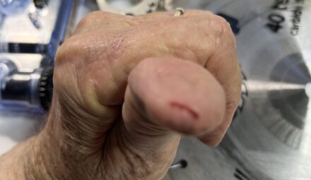 New SawStop Prevents Serious Injury 